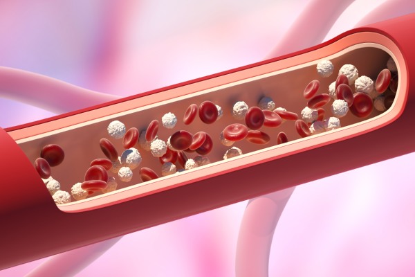 慢性淋巴細胞白血病